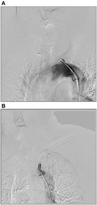 Endovascular Treatment of Chronic Total Occlusion in the Subclavian Artery: A Review of 23 Cases